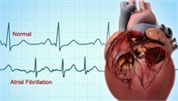 Fibrilația atrială, "ucigașul din umbră" care provoacă accidentul vascular cerebral